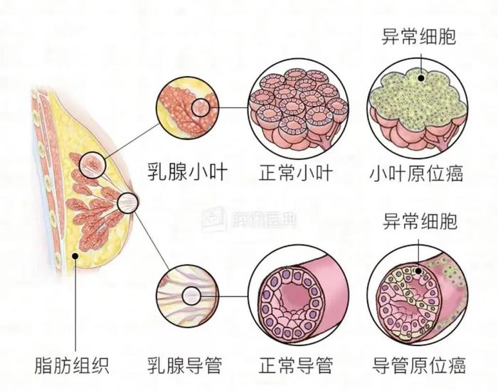 护士妹妹你糊涂啊！年年给人查乳腺，却把自己的结节熬成癌