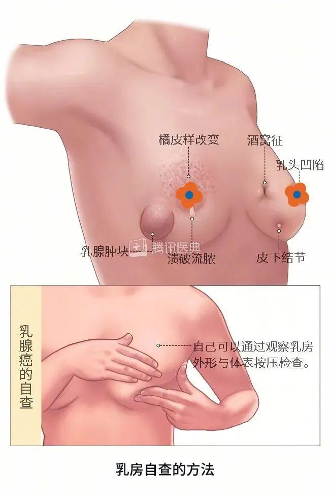 护士妹妹你糊涂啊！年年给人查乳腺，却把自己的结节熬成癌