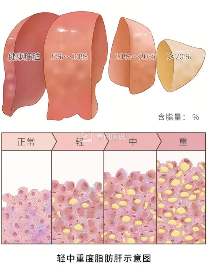 腿粗屁股大的人，竟然更长寿！但有1个前提......