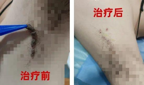 身上的小疙瘩很可怕？震元堂中医院医生帮您来排“疣”