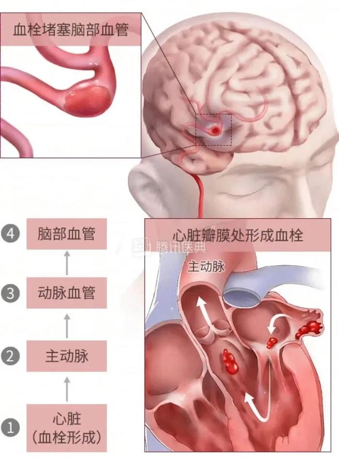 17岁男生踢足球猝然倒地，整个家族的“心事”藏不住了