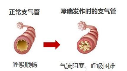 李大爷的“神奇”哮喘偏方