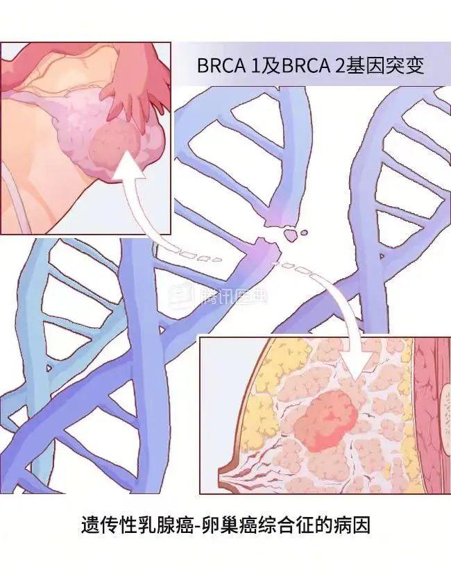 乳腺癌会遗传吗？