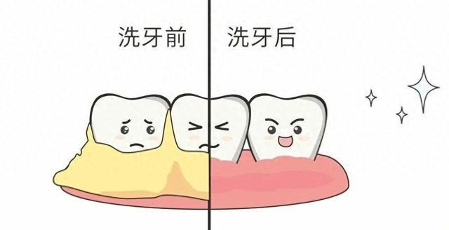 洗牙中的喷砂和抛光有什么区别？丨贤医健康说