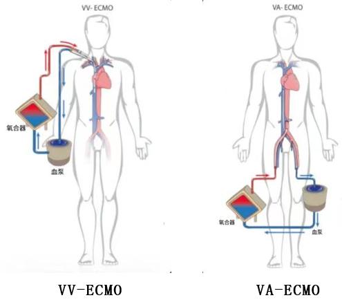 他们得了流感，抢救用上了ECMO！专家：中青年人不要笃信自己的身体底子！