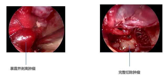 耳内镜下精准切除中耳“定时炸弹”