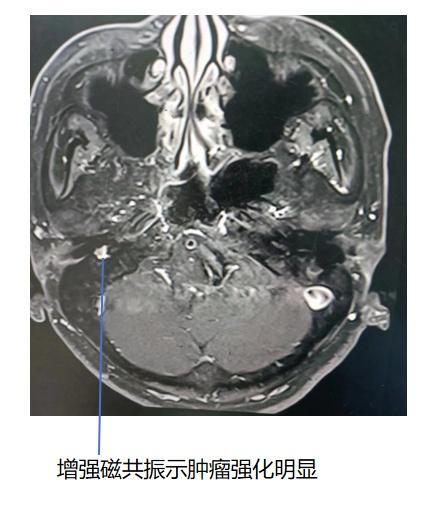 耳内镜下精准切除中耳“定时炸弹”