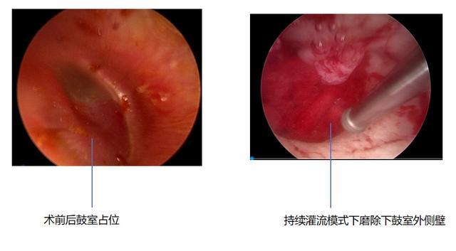 耳内镜下精准切除中耳“定时炸弹”