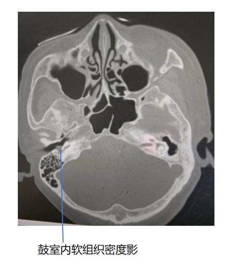 耳内镜下精准切除中耳“定时炸弹”