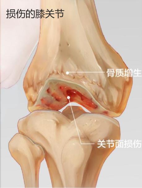 膝关节为何会损伤？换了人工关节啥感觉？一文了解→