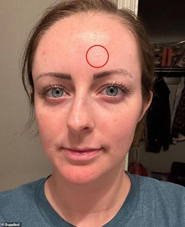 女子31岁改变护肤习惯，额头长一个几乎看不见的痘，医生告诉了她一个坏消息……