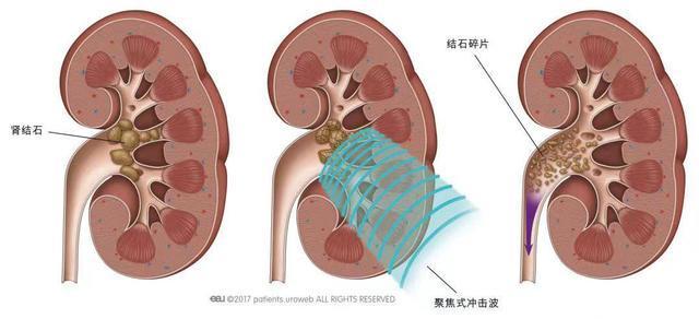 热闻|看演唱会肾结石被“震碎”，网友：意外惊喜？专家回应……