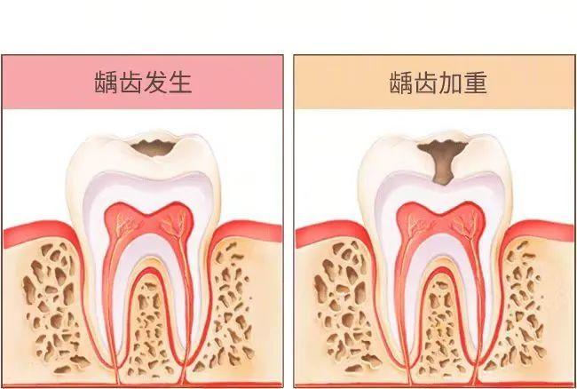 经常口臭的人，一般都逃不过这 2 个原因