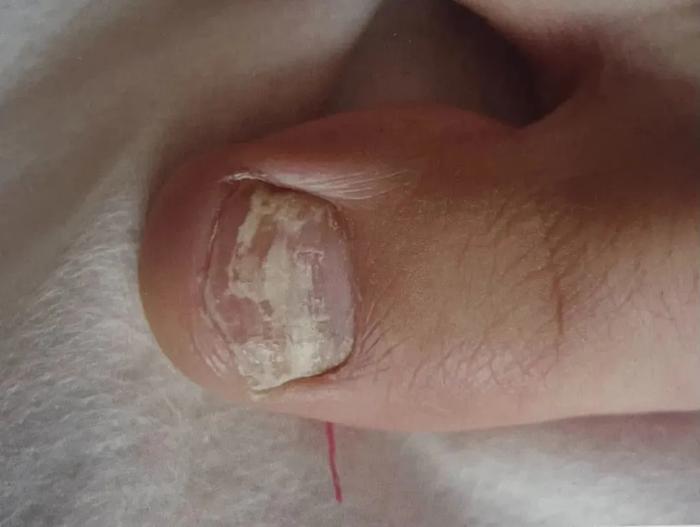股癣、灰指甲、脚气……被真菌感染后不及时治疗会怎样？