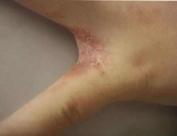 股癣、灰指甲、脚气……被真菌感染后不及时治疗会怎样？