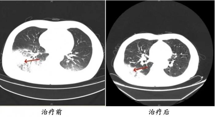 “军团菌”藏身空调，接连有人确诊，严重者可致死！紧急提醒→