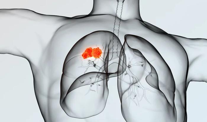 良医 | 晚期肺癌距离“慢病化”，还有多远？