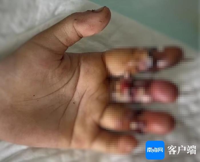 海口6岁男童被奶茶封口机切断三根手指 医生手术6小时成功接活