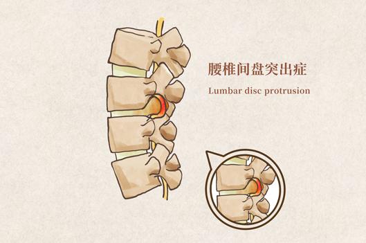 低周波技术——缓解腰椎间盘突出的康复利器！