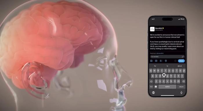 马斯克脑机接口公司 Neuralink：首位患者芯片植入物的细线现已稳定
