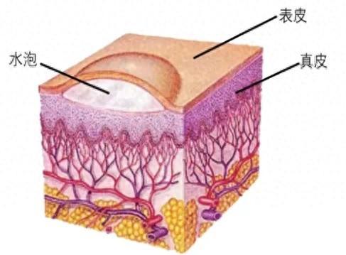 张力性水泡能直接戳破吗？