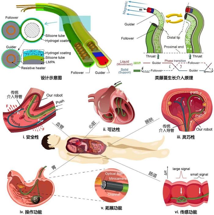 哈工大团队研发毫米级连续体机器人助力腔内介入手术精准安全