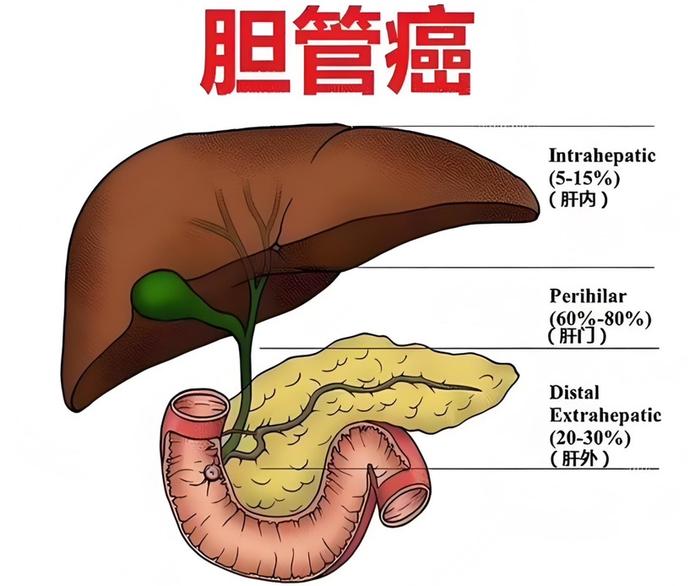 夏令科普｜不要生食水产品！这些胆管癌的高危因素需关注