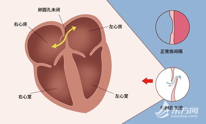 年轻患者长期受偏头痛困扰 市七医院“一招”解忧