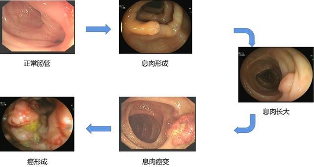 肠息肉要治疗吗？