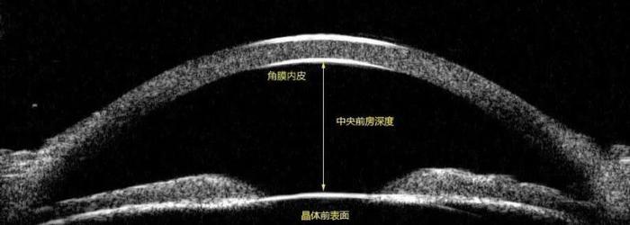 最适合ICL晶体植入的几类近视人群，看看有你吗？