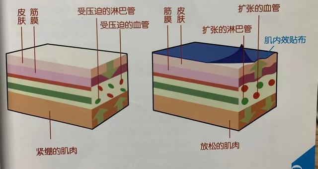 运动员身上贴的五彩胶布是干嘛的？我们能贴吗？