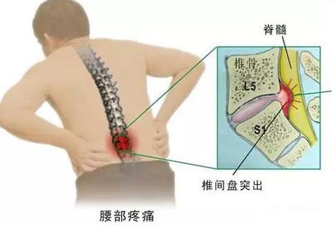 腰椎盘突出患者注意事项