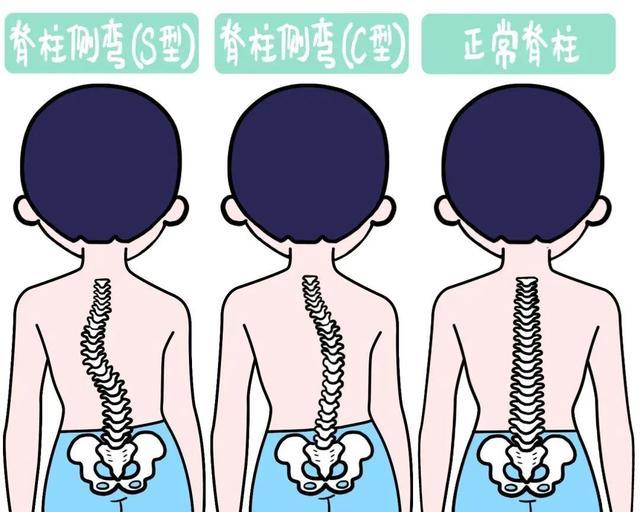 假期脊柱侧弯门诊就诊激增 3小时手术拉直60度“扭曲人生”