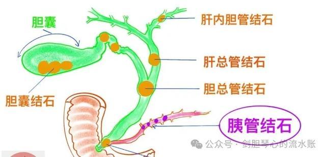 胰管是啥？“胰管扩张”又是什么警示信号？