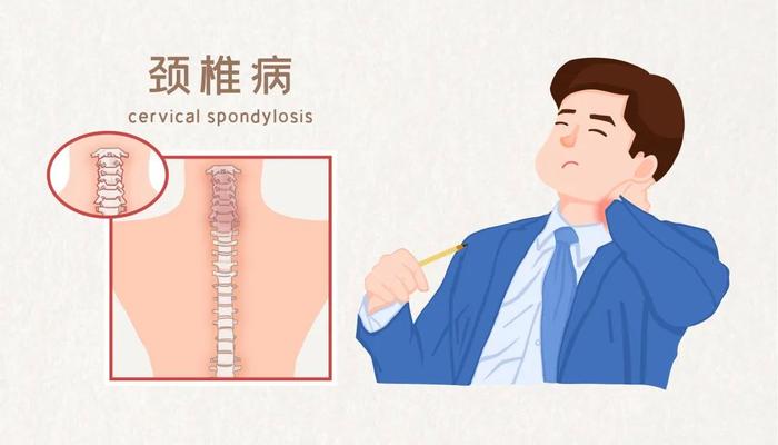 四种类型颈椎病，哪一种最不好惹