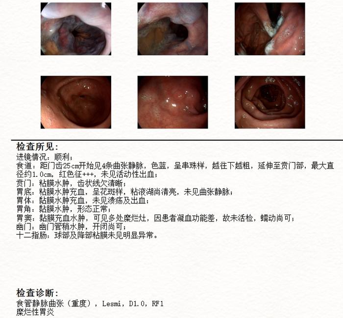 “净”获新生，扬“帆”起航——PE联合DPMAS治疗乙型肝炎相关慢加急性肝衰竭病例分享