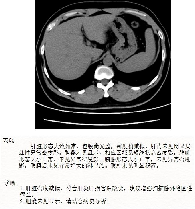 “净”获新生，扬“帆”起航——PE联合DPMAS治疗乙型肝炎相关慢加急性肝衰竭病例分享