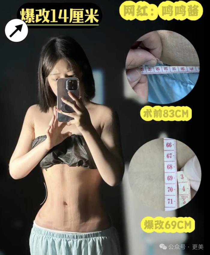 为王思聪生下女儿后，黄一鸣紧急吸脂、重回少女腰！