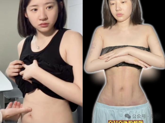 为王思聪生下女儿后，黄一鸣紧急吸脂、重回少女腰！