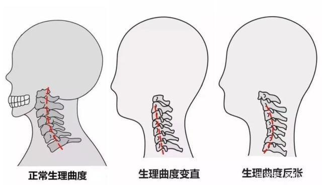 年轻人跑医院“吊脖子”？快来测测你有颈椎问题吗→