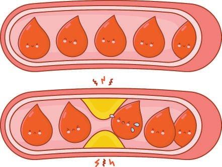 哪些行为会给血管“添堵”