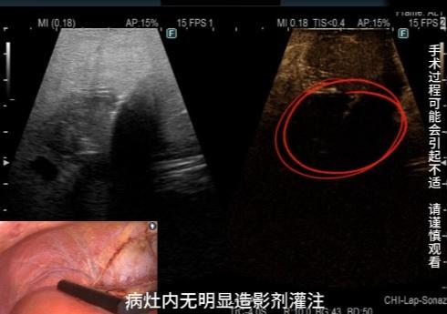 稽疑送难丨微波消融