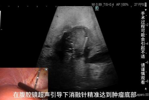 稽疑送难丨微波消融