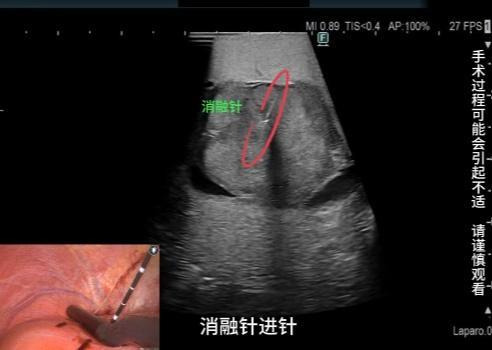 稽疑送难丨微波消融