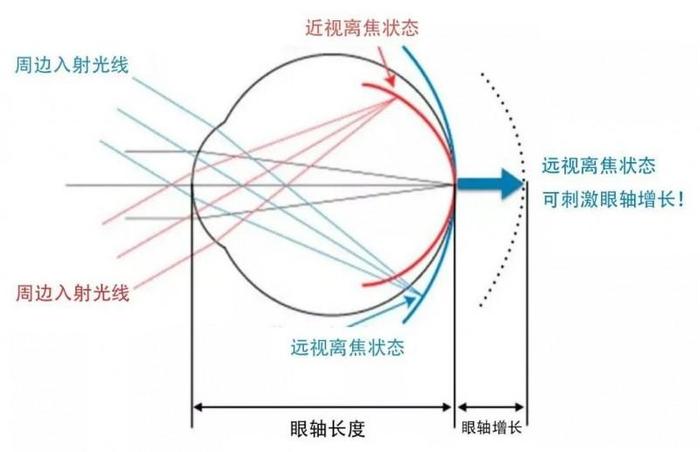 成都爱尔林江院长解析角膜塑形镜的利与弊