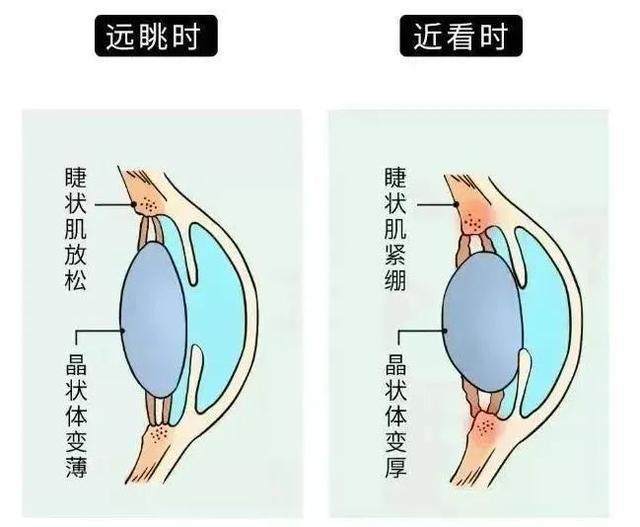 可怕！视力暴跌至0.1，合并白内障！这款“神器”很多人在用，医生紧急提醒→