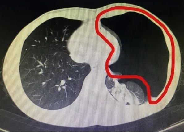 男子排便时太用力，竟把肺憋“炸”了！医生提醒：排便切忌用力过猛，多种风险后果严重→