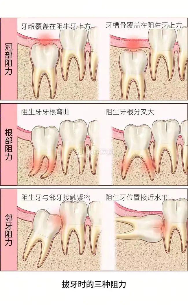 一次性拔掉4颗智齿，可以吗？