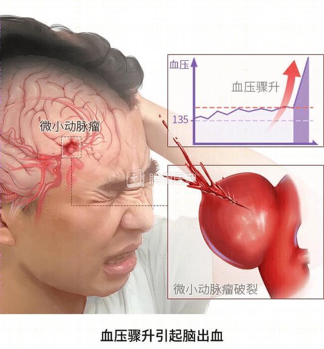 在直播后突发脑溢血被送进ICU