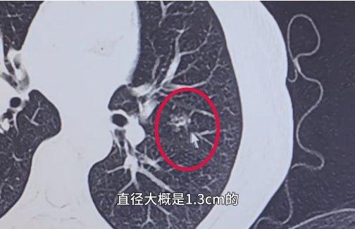 高龄肺结节患者伴心脏病，广州复大冷冻消融术为患者解“心结”